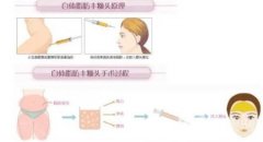 50歲脂肪填充維持多久