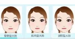 介紹面部吸脂術后7天的恢復情況