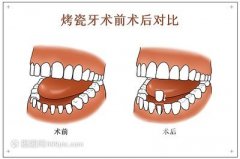 烤瓷牙的價(jià)格是由多個(gè)因素決定的