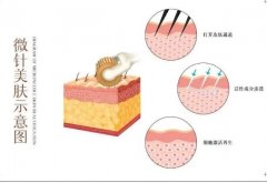 微針調(diào)節(jié)間隔時間的醫(yī)美知識