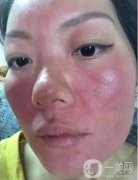 激素臉：癥狀、排毒與修復的探索