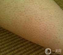擺脫“雞皮膚”：理解、預防與調(diào)節(jié)