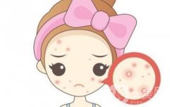 痘痘肌的福音!揭秘致痘成分，讓你遠(yuǎn)離痘痘困擾