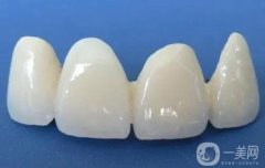 烏魯木齊烤瓷牙多少錢？烤瓷牙的適宜人群盤點(diǎn)