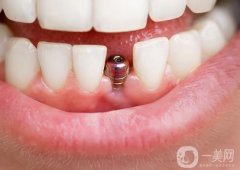 無錫種一顆牙價(jià)格多少錢？種植牙品牌怎么選？附五家靠譜醫(yī)院介紹