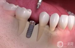 佛山種牙多少錢一顆?。績r(jià)格費(fèi)用詳細(xì)_靠譜醫(yī)院測評3家