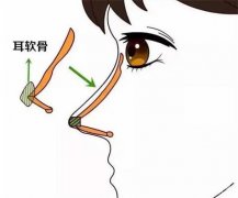 肋骨隆鼻多少錢？肋骨隆鼻和耳軟骨哪個(gè)好？醫(yī)院點(diǎn)評(píng)