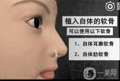 北京李明醫(yī)生隆鼻案例分享，專家簡(jiǎn)介+所在醫(yī)院資料超詳細(xì)了解