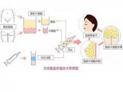 太原美媛薈整形醫(yī)院脂肪填充價(jià)格表2024搶先看！附真實(shí)案例分享