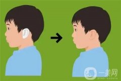 揭秘耳朵整形：價格揭秘，風險解讀，別再被蒙在鼓里了！