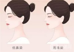 鼻整形手術(shù)后怎么快速消腫