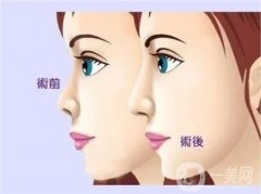鼻翼縮小術(shù)后有哪些后遺癥