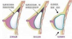 假體隆胸怎么樣，術(shù)后怎么護(hù)理