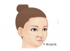 矯正鷹鉤鼻手術(shù)的效果如何呢？
