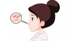 鼻孔縮小手術(shù)是否安全？是否有風(fēng)險