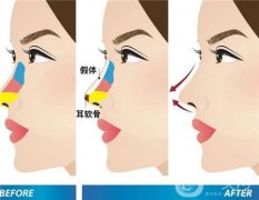 鼻部整形后多久可以洗頭