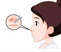 鼻翼縮小術(shù)后有哪些后遺癥