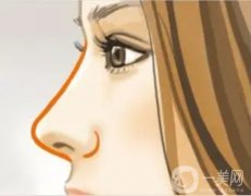鼻小柱延長手術(shù)失敗后如何進(jìn)行修復(fù)呢？