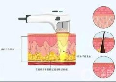 超聲刀是否會激發(fā)膠原蛋白呢？
