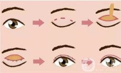 雙眼皮手術(shù)后的康復(fù)過程