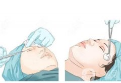 雙眼皮手術(shù)后需要注意什么事項(xiàng)