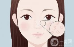 填充蘋(píng)果肌的作用有哪些？