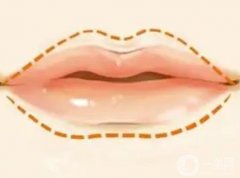 兔唇修復(fù)需要多少錢？是否存在風(fēng)險？