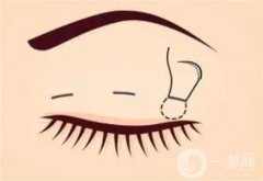 完成微創(chuàng)雙眼皮手術(shù)之后的注意事項