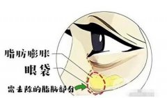 眼袋去除手術(shù)失敗怎么辦？