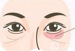 眼袋手術(shù)是否存在風(fēng)險(xiǎn)，具體有哪些方式呢？
