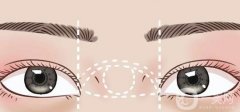 開內(nèi)眼角手術(shù)的價格影響因素