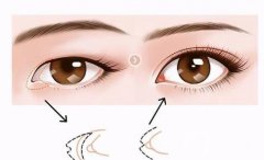 開眼角手術(shù)失敗修復(fù)的成本貴嗎？