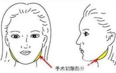 切骨瘦臉手術(shù)可能出現(xiàn)哪些并發(fā)癥？