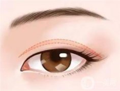 疤痕體質(zhì)是否適合割雙眼皮？