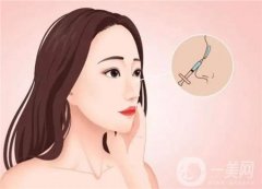 鼻綜合有后遺癥嗎？要注意哪些事項(xiàng)
