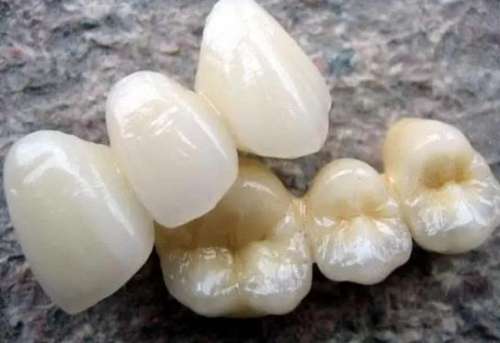 烤瓷牙套價(jià)格曝光：如何根據(jù)需求找到適合自己的價(jià)格？