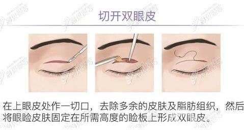 開眼角眼睛會(huì)變大是真的嗎？